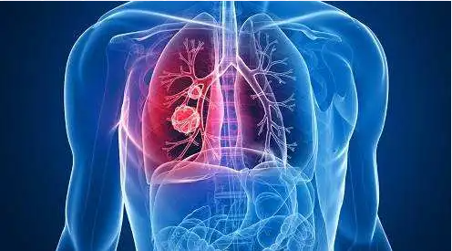  肺癌诊疗的侦察兵--凤凰医院呼吸科常规开展CT引导下经皮肺穿刺活检术