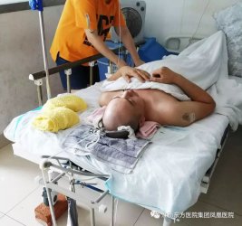 高位颈椎骨折病人成功脱险案例——刘春生院长成功实施经后路C2椎体骨折内固定高难度手术